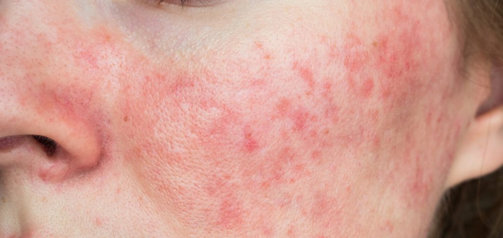 Rosacea Treatment