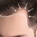 Fotona Laser for Hair Growth